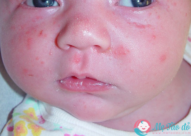 8 căn bệnh về da phổ biến trẻ sơ sinh nào cũng dễ mắc, các mẹ đang nuôi con nhỏ nên lưu ý - Ảnh 3.