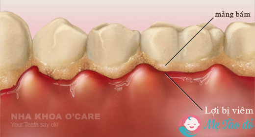 trẻ 6 tuổi bị viêm lợi nên làm gì