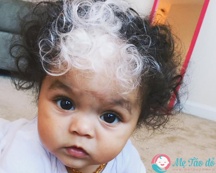 Tại sao tóc bạc sớm ở trẻ?